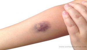 7 Razones no muy evidentes para la aparición de hematomas con facilidad