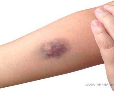 7 Razones no muy evidentes para la aparición de hematomas con facilidad