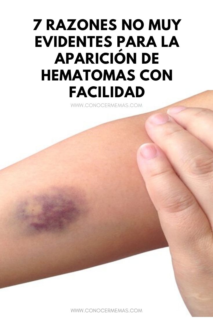 7 Razones no muy evidentes para la aparición de hematomas con facilidad